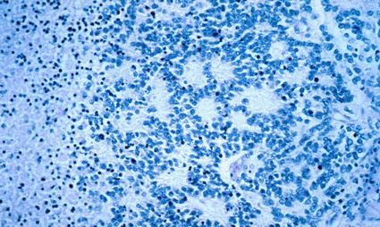 Image: A microscopic view of a typical neuroblastoma with rosette formation (Photo courtesy of the National Cancer Institute).